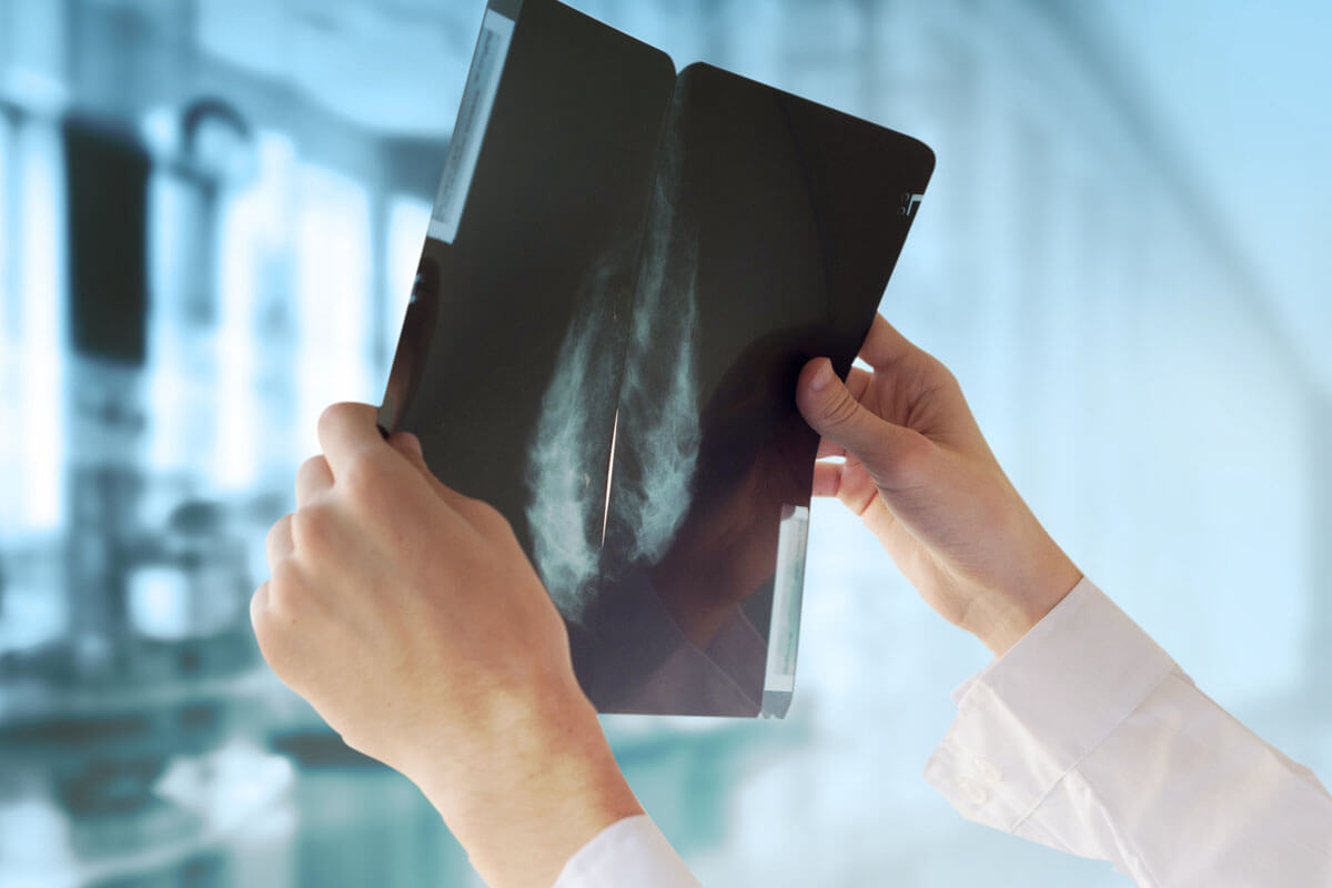  Zentrale Maßnahme beim Brustkrebsscreening: Die Röntgenuntersuchung der Brust.